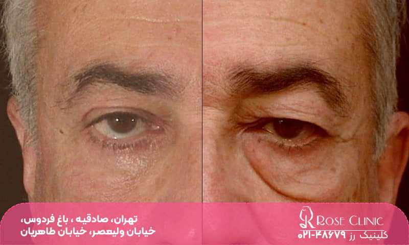 آیا عمل بلفاروپلاستی خطرناک است​؟