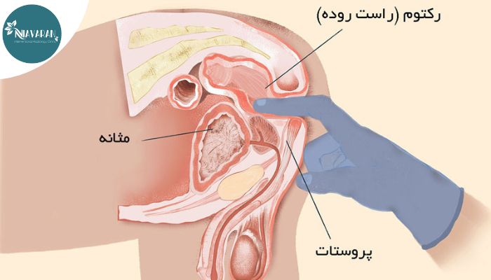 آیا بزرگی پروستات می تواند بر روی باروری شما تاثیر بگذارد؟