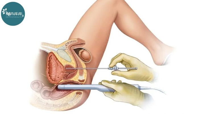 آیا بزرگی پروستات می تواند بر روی باروری شما تاثیر بگذارد؟