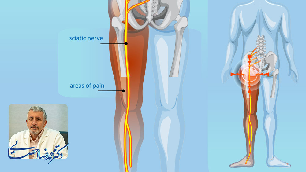 بهترین دکتر سیاتیک مشهد