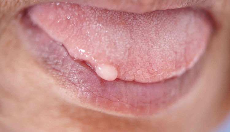 ویروس پاپیلومای انسانی (Human Papillomavirus) به‌اختصار HPV