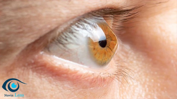با لنز نوع اسکلرال بیماریهای قرنیهای درمان می شوند