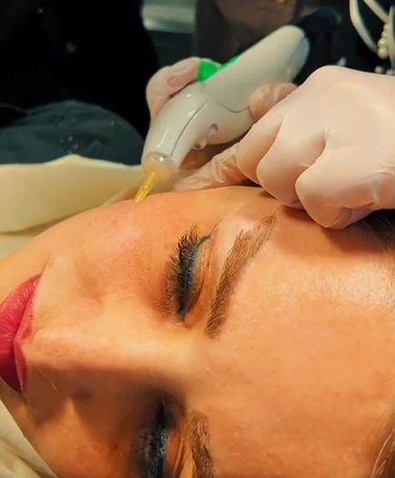 رفع چین و چروک صورت با کربوکسی تراپی رفع چین و چروک صورت با کربوکسی تراپی