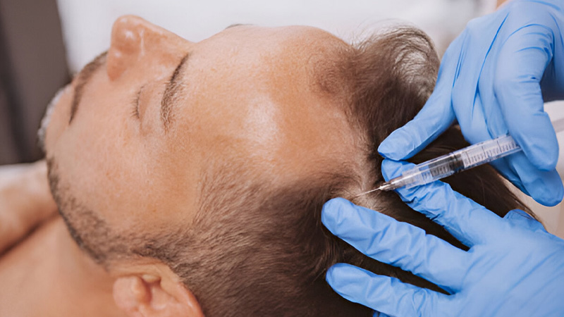 بهترین روش درمان ریزش مو در شیراز