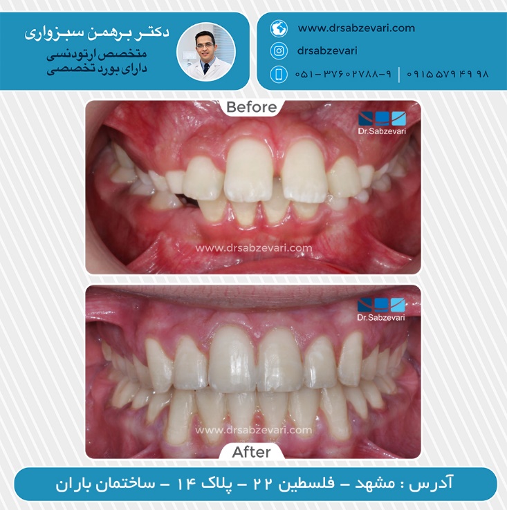 تفاوت بین ارتودنسی معمولی (با نگین و سیم) و ارتودنسی نامرئی