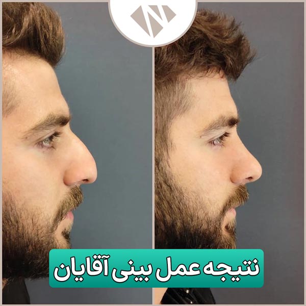نتیجه جراحی بینی آقایان