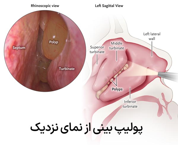 نمای از نزدیک پولیپ بینی
