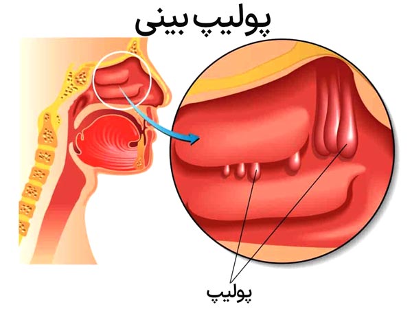 موقعیت پولیپ ها در بینی