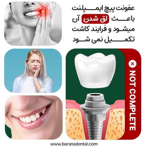 افتادن ایمپلنت به دلیل عفونت