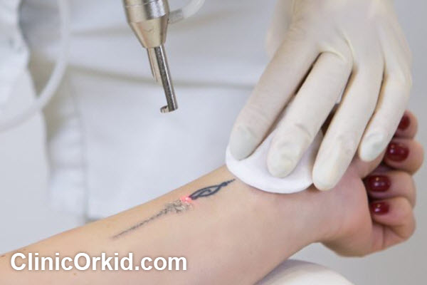 مزایای حذف تاتو با لیزر پیشرفته | کلینیک ارکید