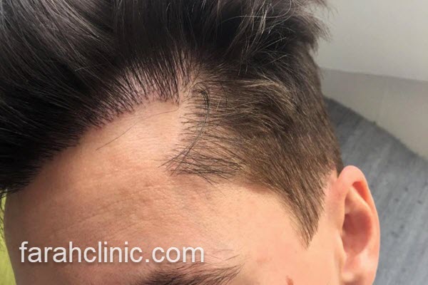 بررسی مزایای انجام کاشت مو | فرح کلینیک 