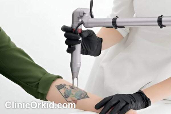 انتخاب بهترین مرکز برای حذف تاتو | کلینیک ارکید