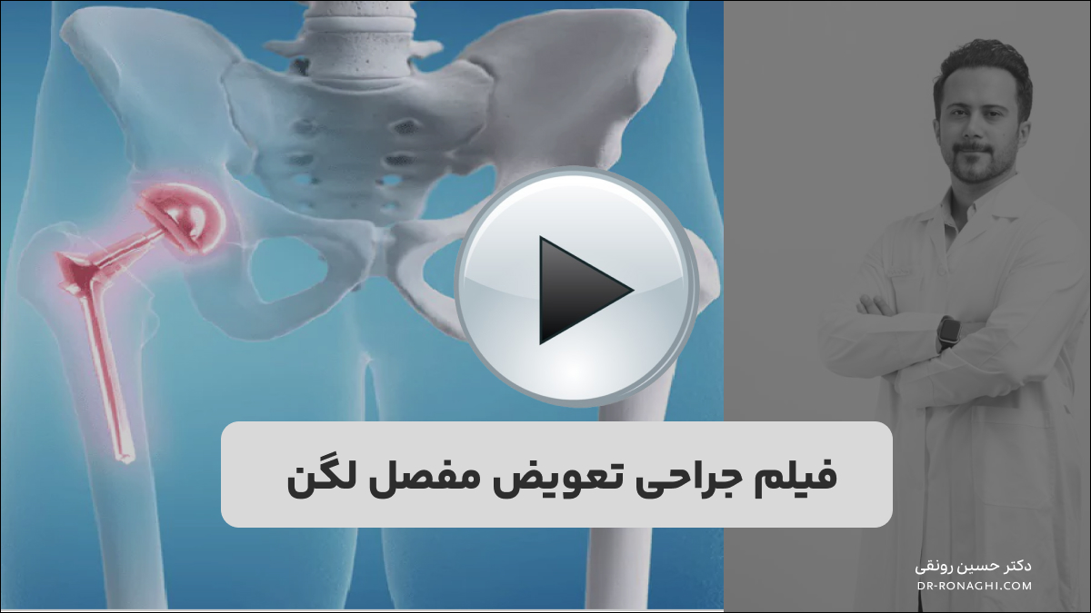 فیلم جراحی تعویض مفصل لگن