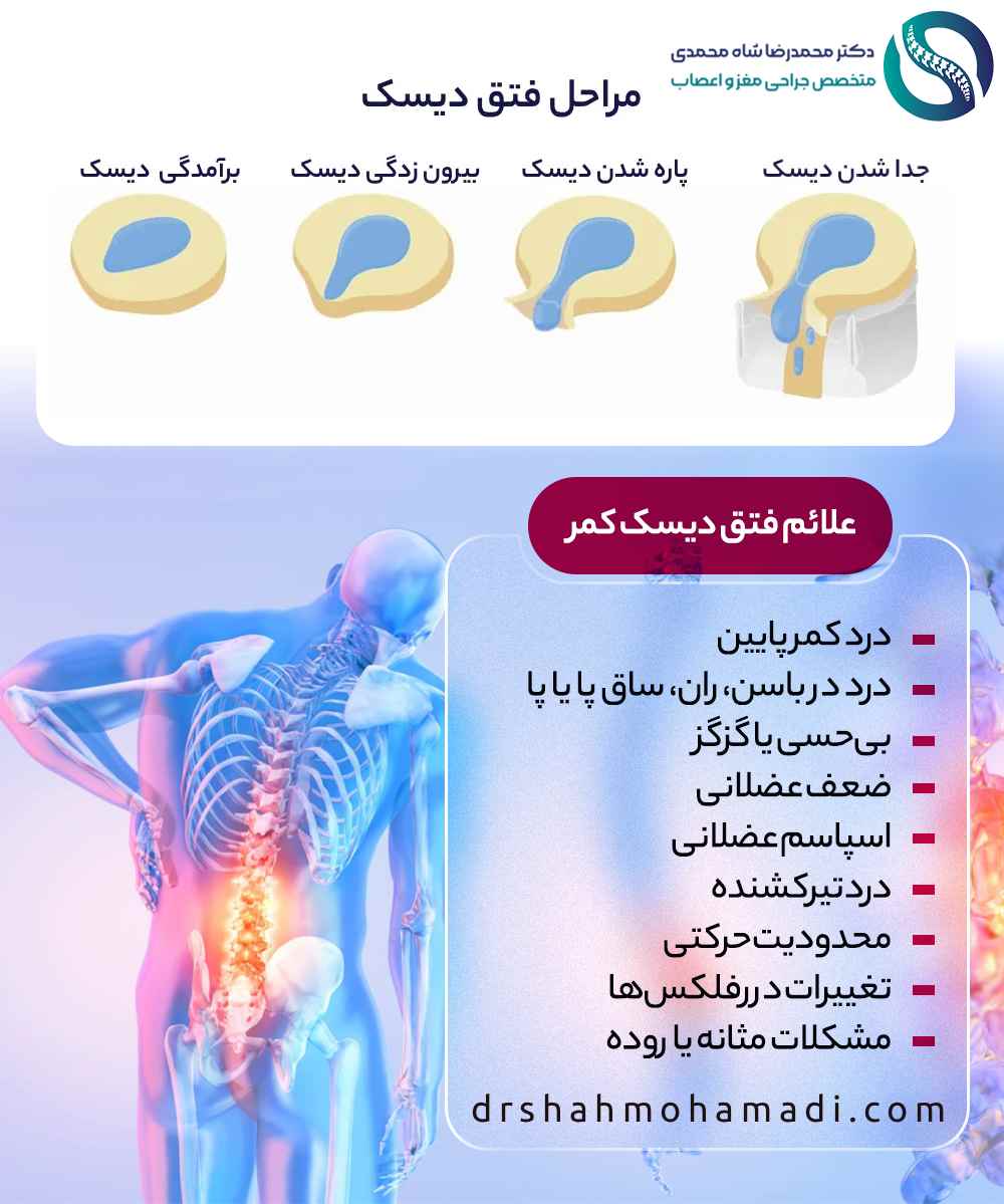 بهترین روش درمان دیسک کمر توسط دکتر شاه محمدی (متخصص دیسک کمر در تهران) 2