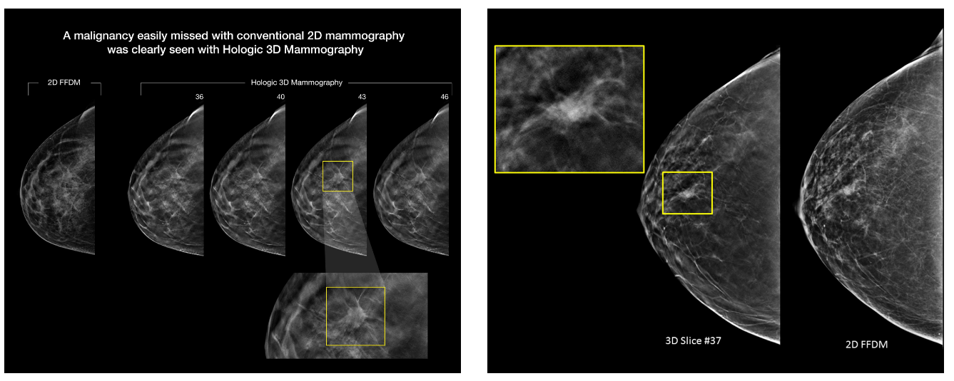 تنها دستگاه ماموگرافی سه بعدی برند هالوژیک آمریکا مجهز به وکیوم بیوپسی و Contrast Enhanced در مازندران