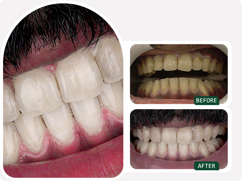 نتیجه هوم بلیچینگ