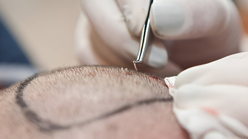 مشاوره پیش از کاشت مو برای بیماران هپاتیتی