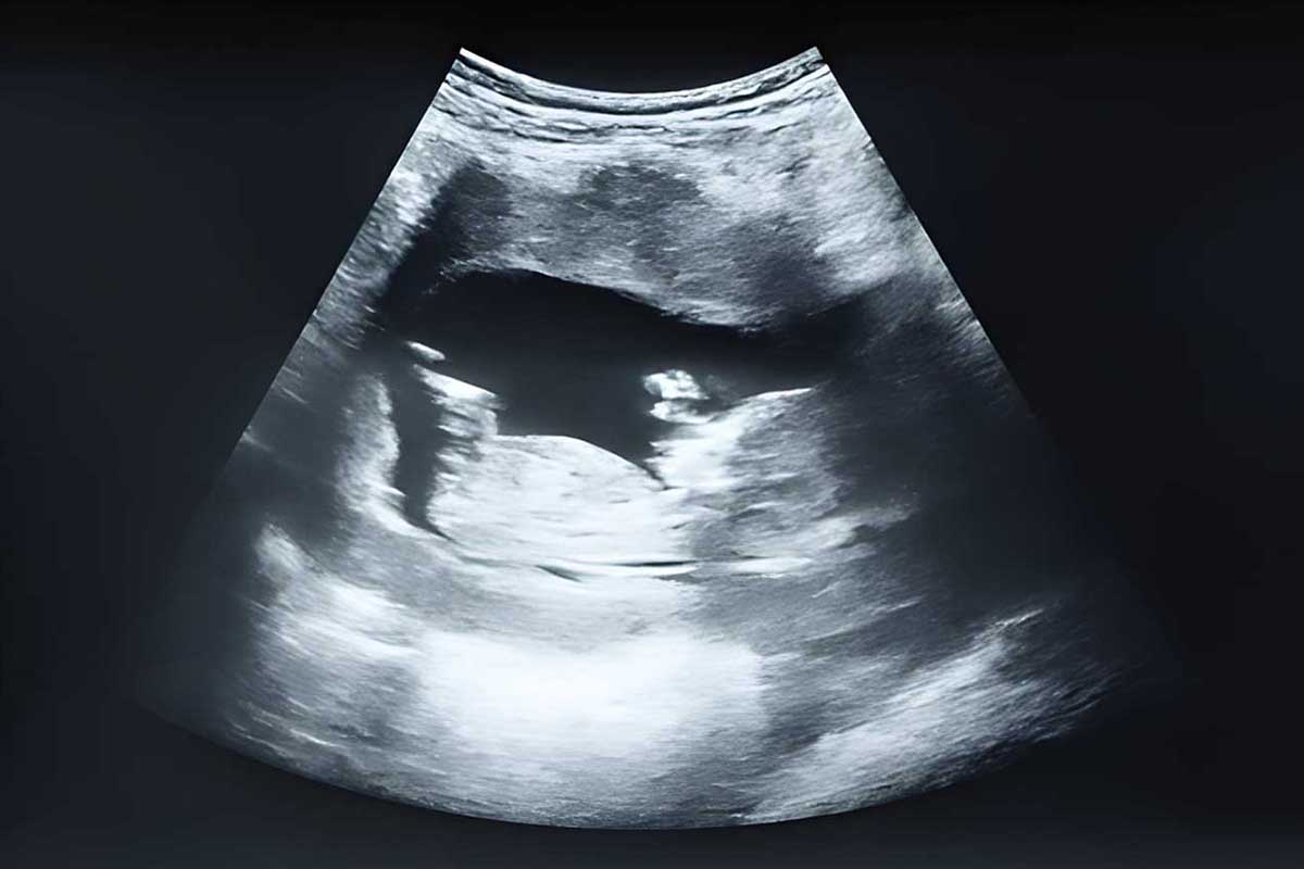 سونوگرافی جنین