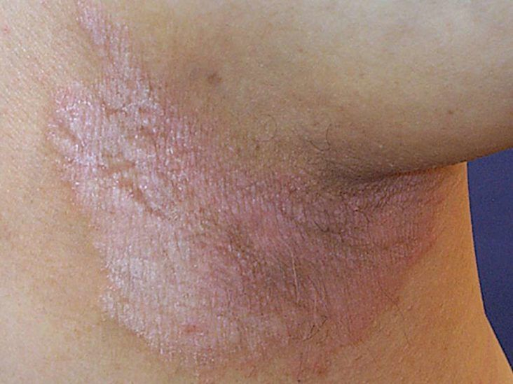 عفونت های قارچی در نواحی صورت و گردن