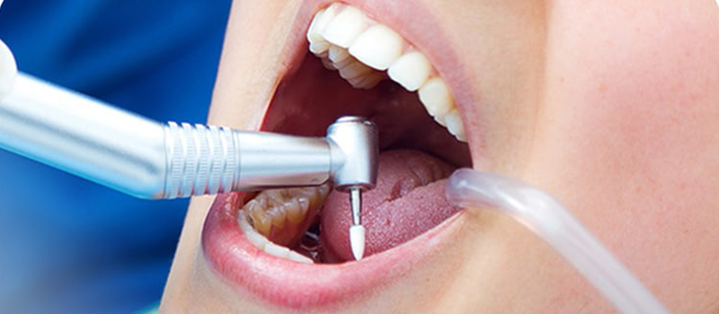 اهمیت عصب‌کشی دندان