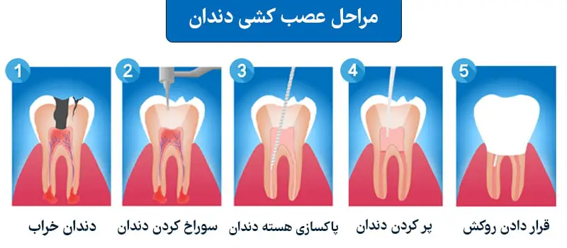 مراحل درمان ریشه