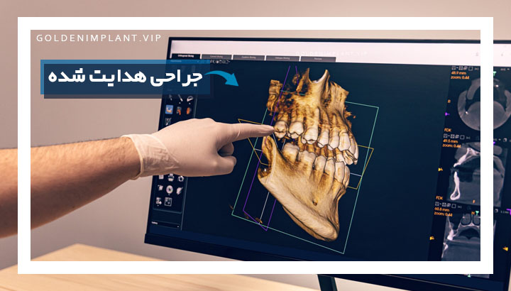 ایمپلنت زیبایی چیست و چه تفاوتی با ایمپلنت معمولی دارد؟