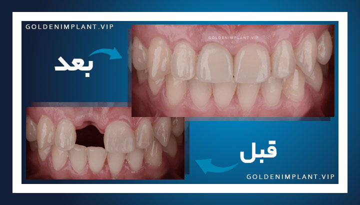 ایمپلنت زیبایی چیست و چه تفاوتی با ایمپلنت معمولی دارد؟
