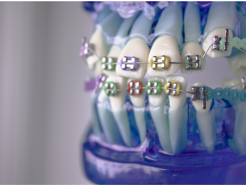 چرا گاهی دندان ها بعد از ارتودنسی باز می گردند؟!