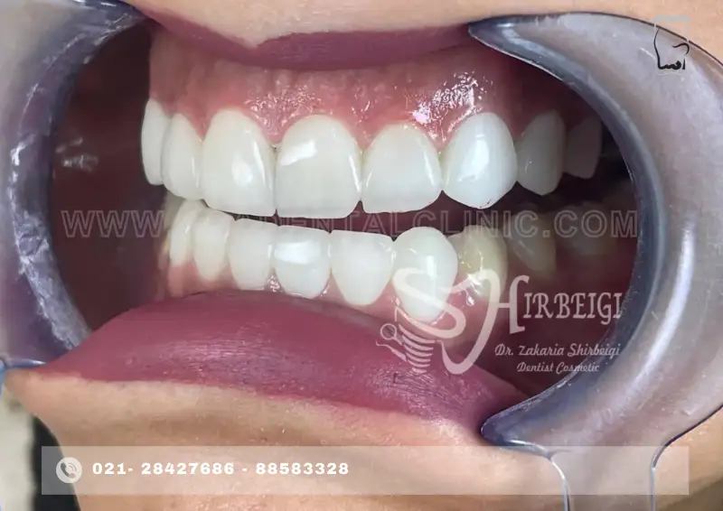 بلیچینگ دندان با قیمت مناسب و کیفیت تضمینی
