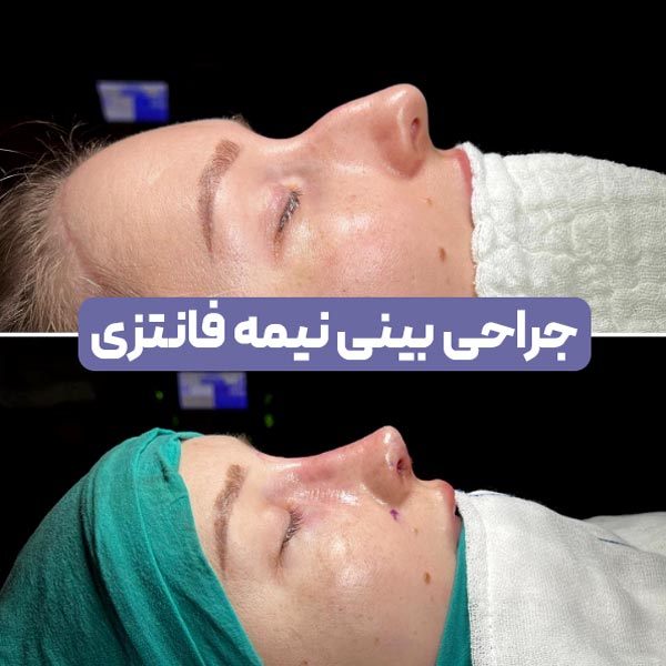 جراحی بینی نیمه فانتزی