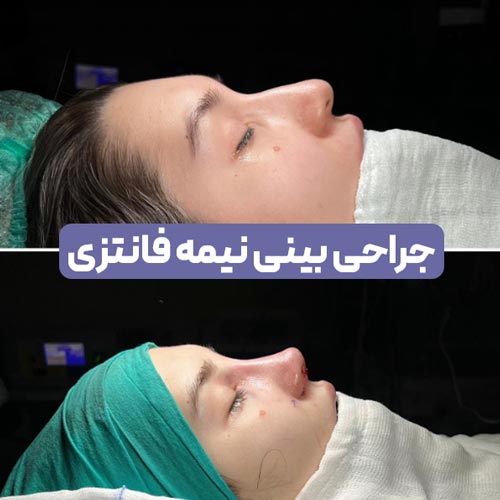 نتیجه جراحی بینی نیمه فانتزی
