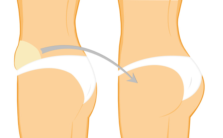 تزریق چربی به باسن