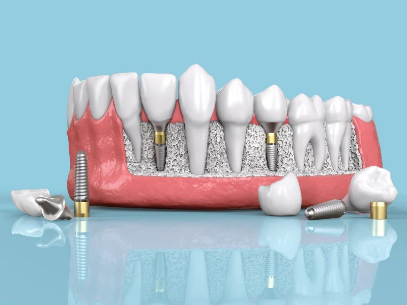 تصویری از ایمپلنت دیجیتال