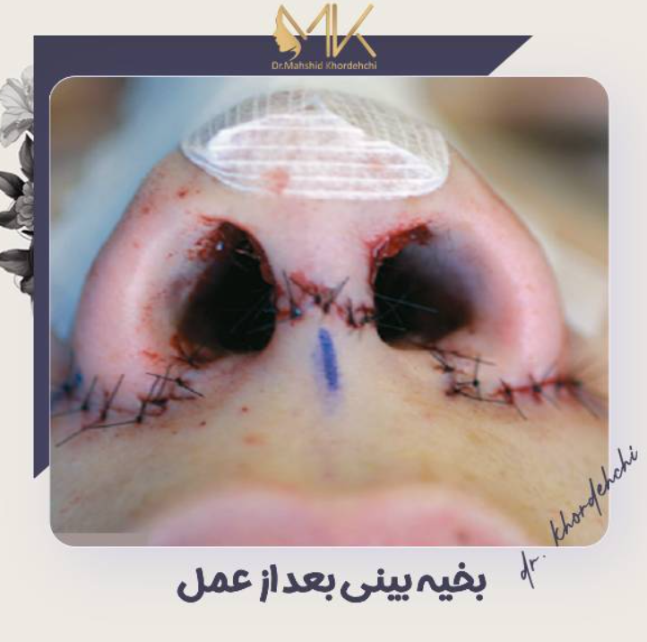 رد بخیه بعد از جراحی بینی