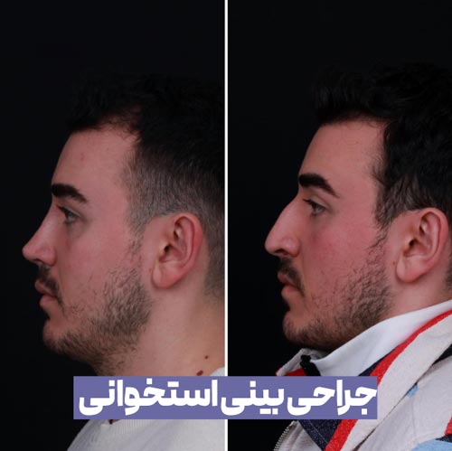 بینی استخوانی