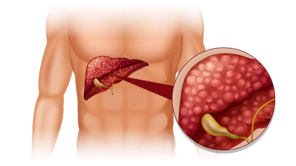 بیماریهای خاموش کبد و الزام به بررسی و پیگیری 2 بیماریهای خاموش کبد و الزام به بررسی و پیگیری