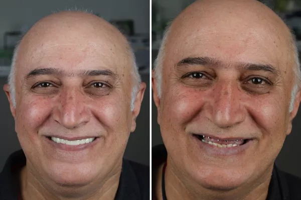 هزینه ایمپلنت کامل فک بالا و پایین
