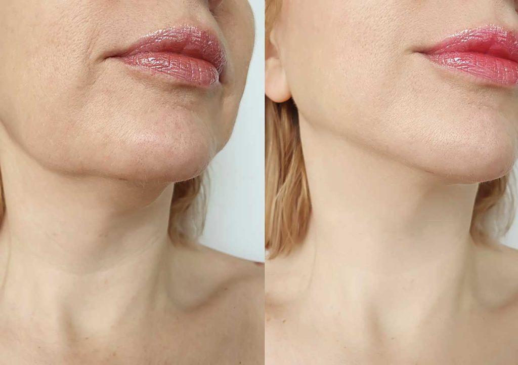 نتایج هایفوتراپی غبغب