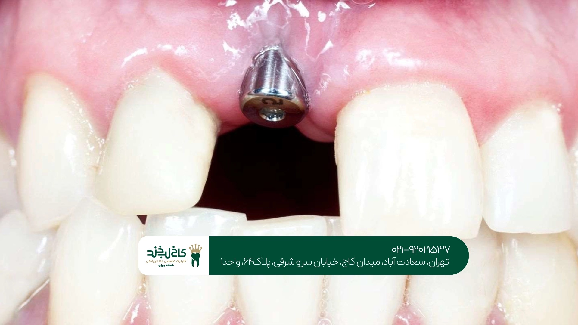 بهترین دندانپزشکی ایمپلنت در تهران
