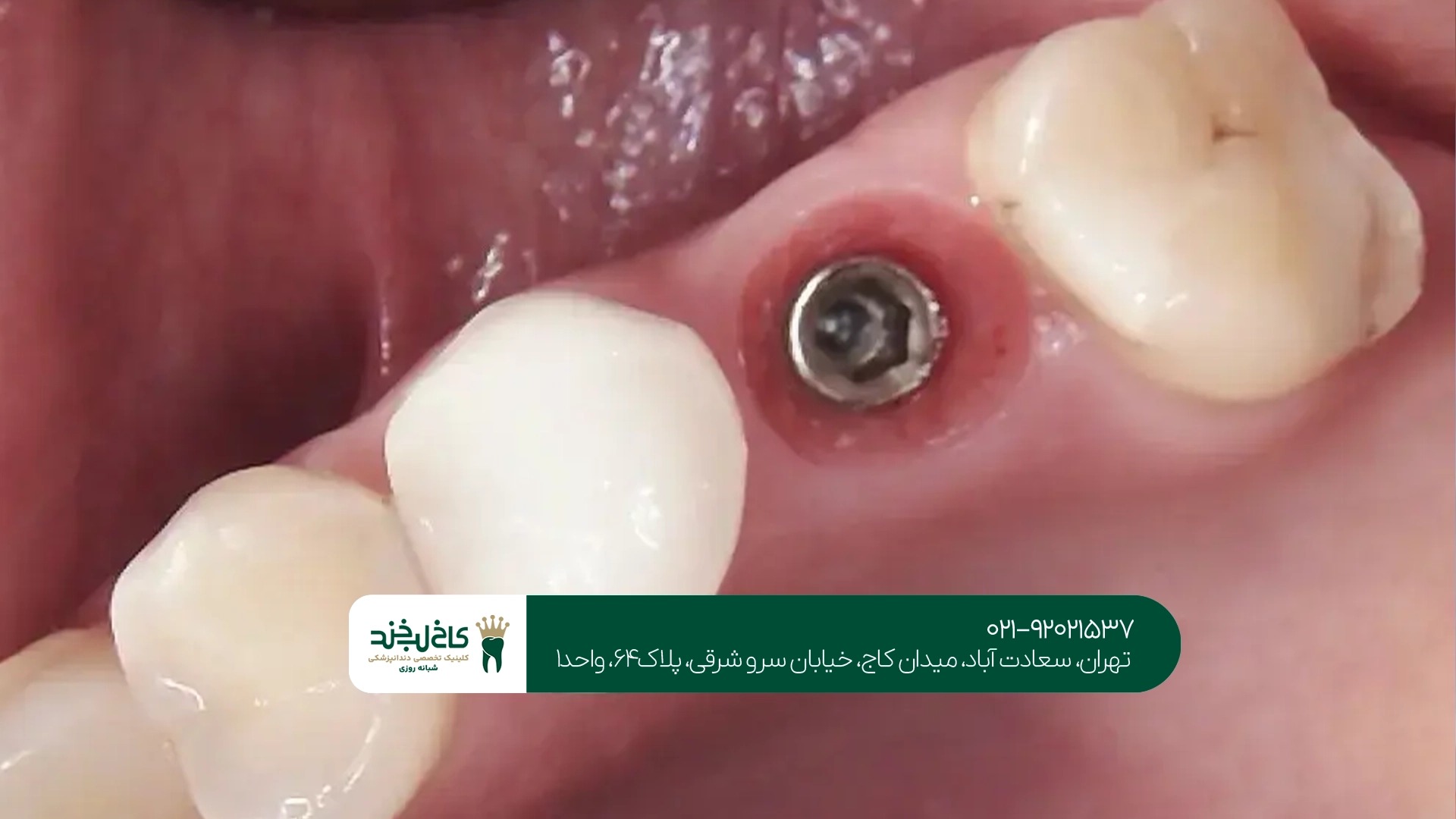 ایمپلنت دیجیتال