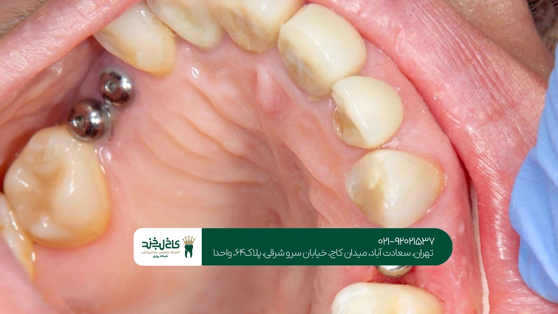 ایمپلنت تک دندان