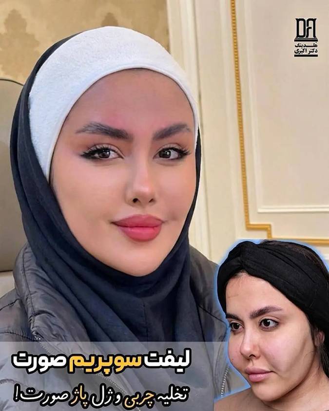 لیفت سوپریم صورت و بررسی ساختارهای عمقی چهره در جوانسازی مدرن