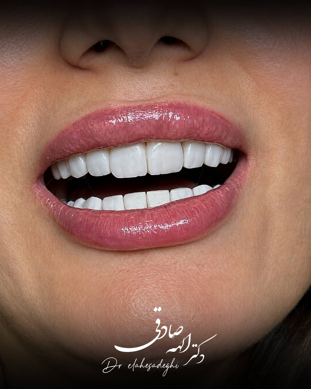 ایمپلنت دندان