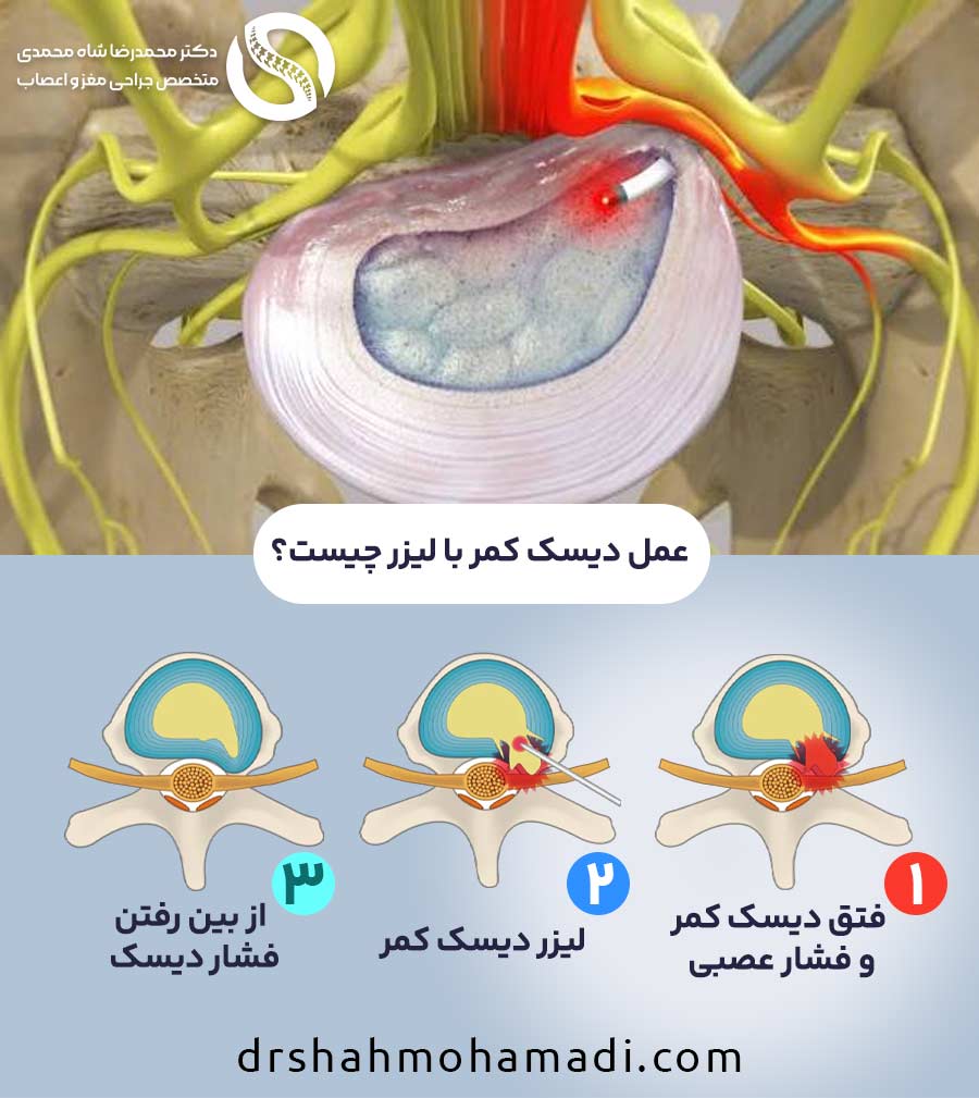 مراحل عمل لیزری دیسک کمر و تاثیر آن بر درمان دیسک کمر