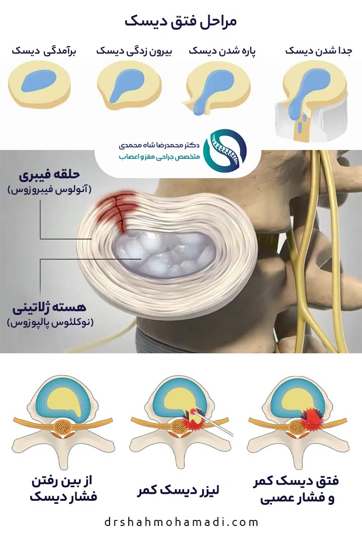 عمل لیزر دیسک کمر چگونه است؟ - عکس تاثیر عمل لیزری دیسک کمر بر درمان دیسک کمر